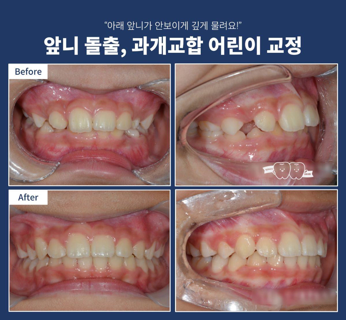 어린이 과개교합 왜, 어떻게 치료 왜 해야 할까?(Why & How) 관련 이미지 1