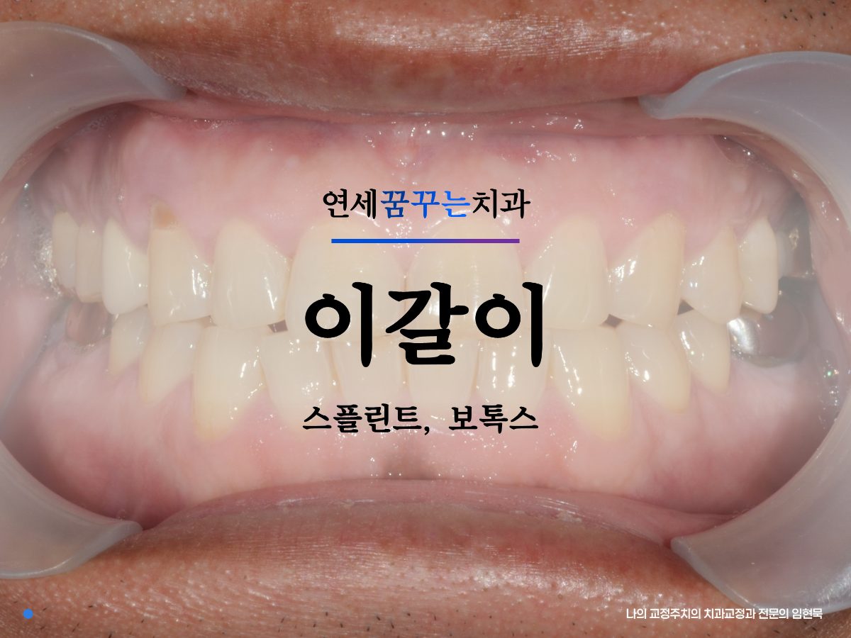 이갈이 스플린트, 아침마다 턱이 아프다면 확인해야 할 것들, 치과 스플린트 비용 대표 이미지