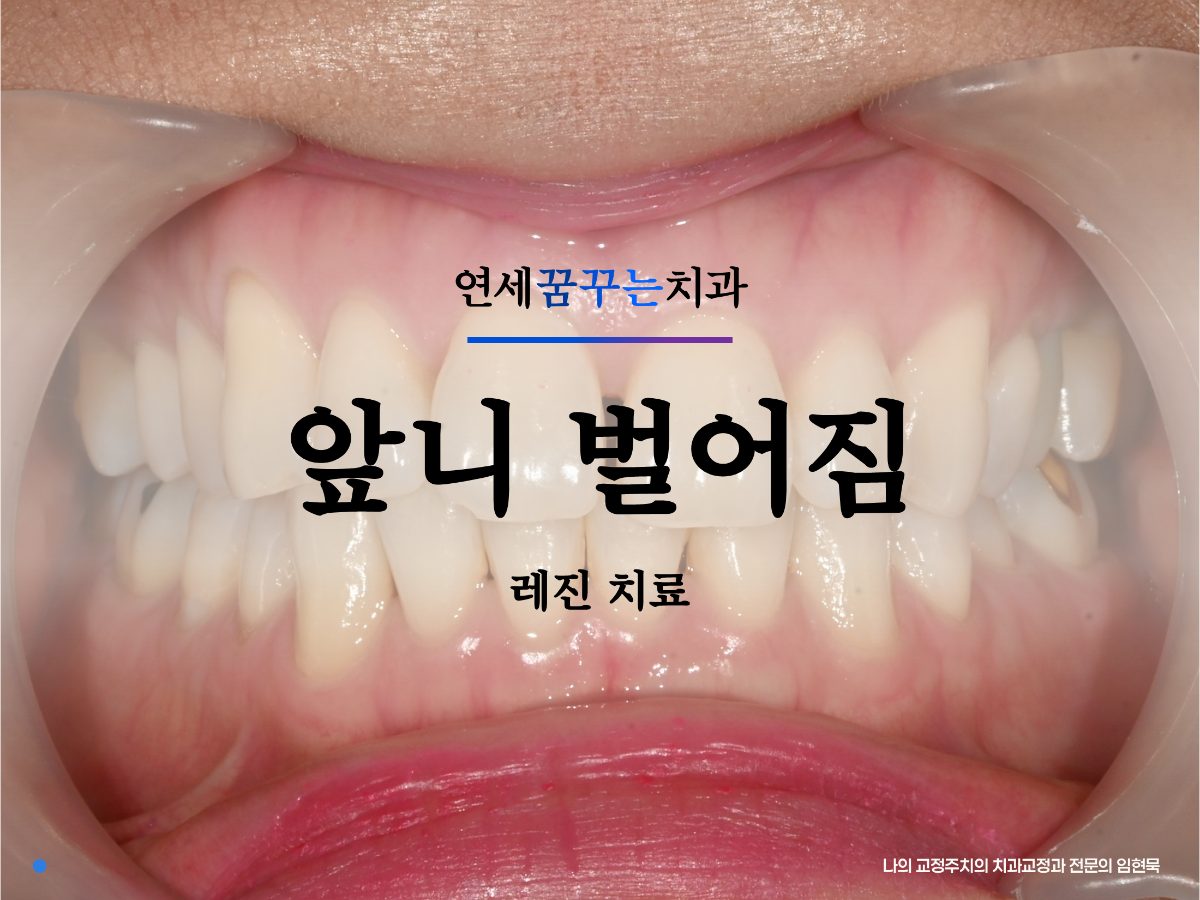 앞니사이 공간, 레진치료시 고려해야 할 요소 대표 이미지