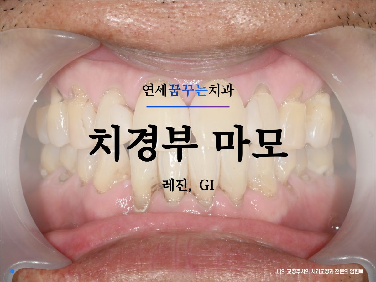 이가 시릴 때 의심해야 할 치경부마모증, 잇몸내려감, 원인부터 치료비용까지 대표 이미지