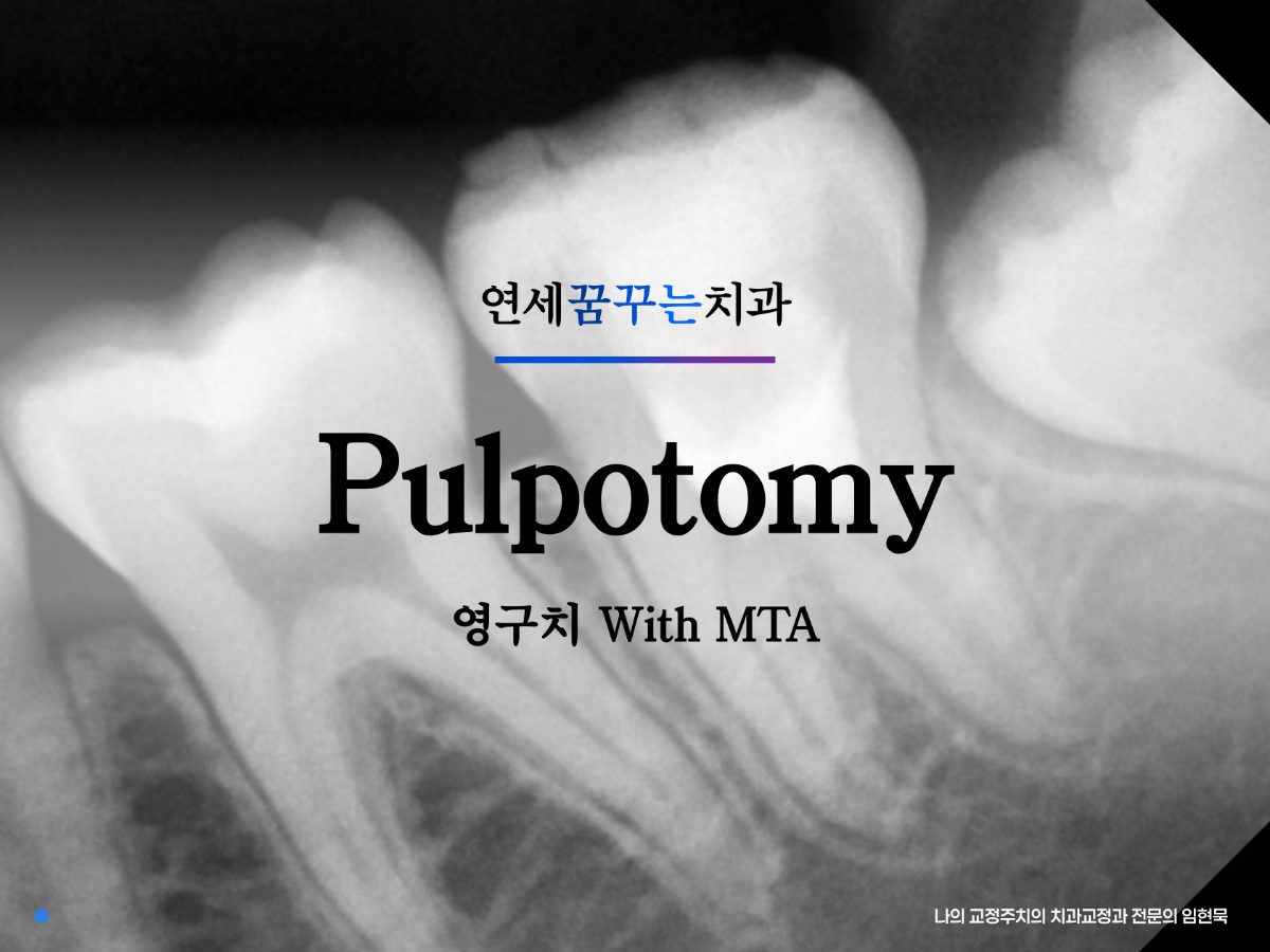 어금니 통증, 신경치료 대신 MTA 펄포토미 가능할까요? 치아보존 치 대표 이미지