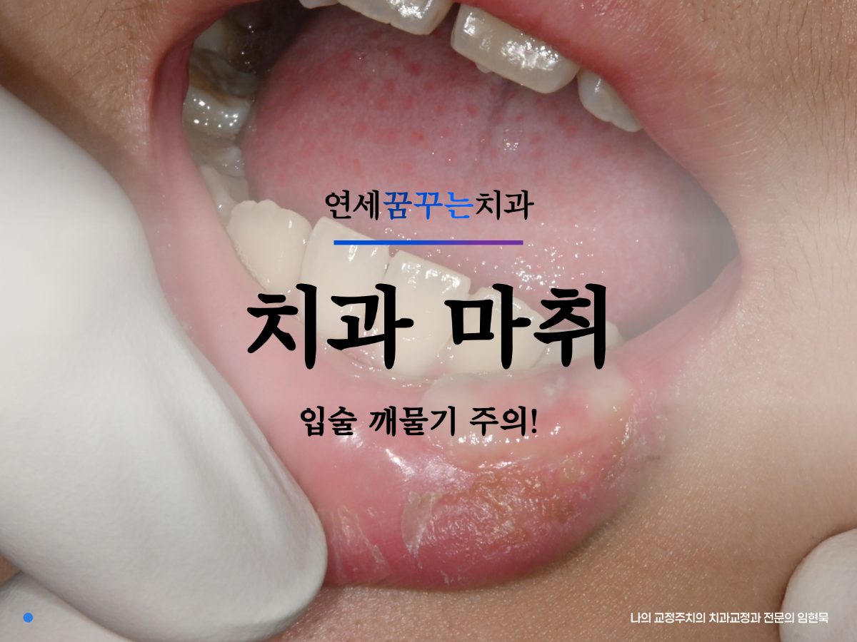 치과 마취 후 입술 씹었어요, 왜 이럴까요? 대표 이미지