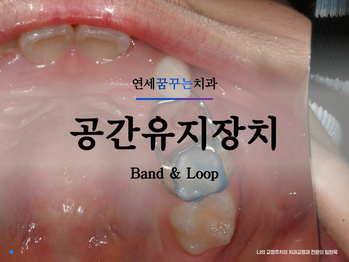 유치가 일찍 빠졌어요, 공간유지장치(밴드앤루프, band and loop)가 꼭 필요한가요? 대표 이미지