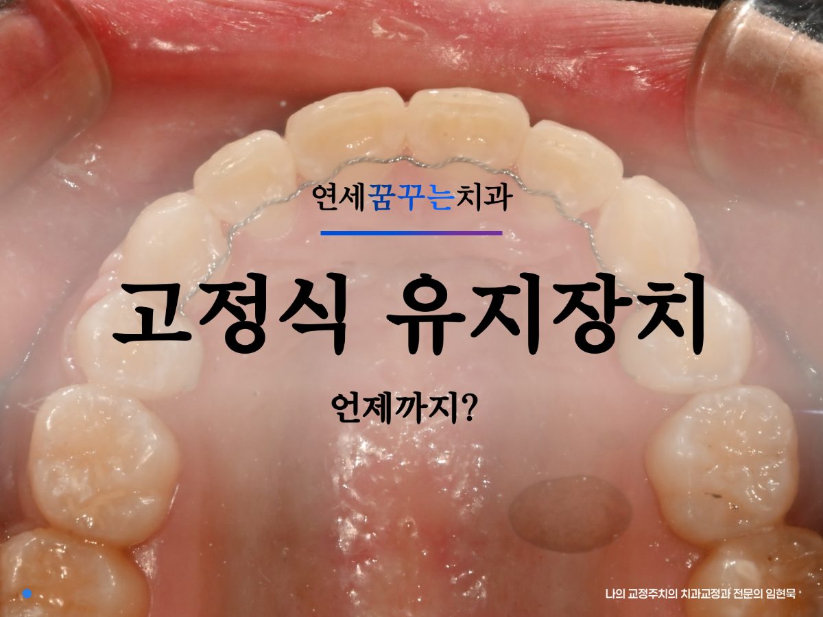 교정 유지장치, 고정식은 언제까지 착용해야 할까요? 대표 이미지