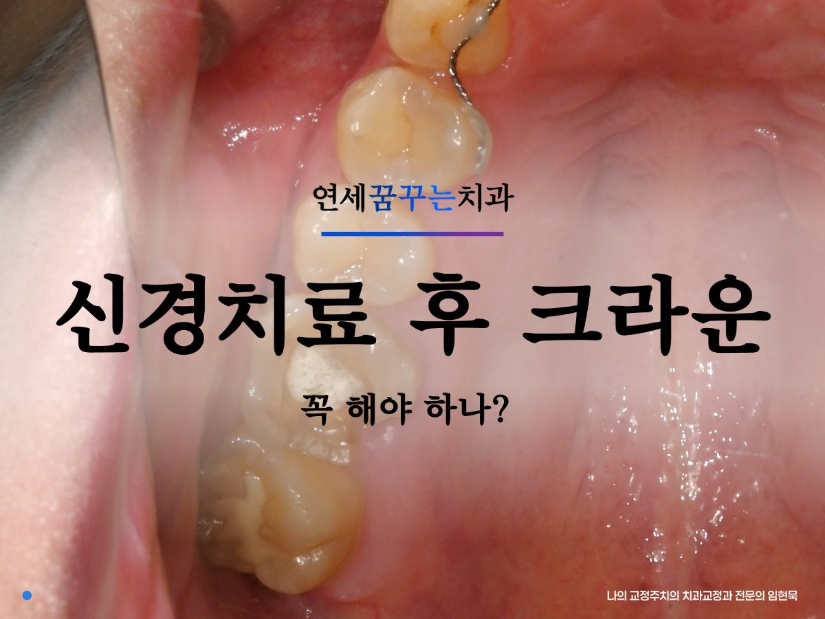 신경치료 후 크라운, 꼭 해야 할까요? 대표 이미지