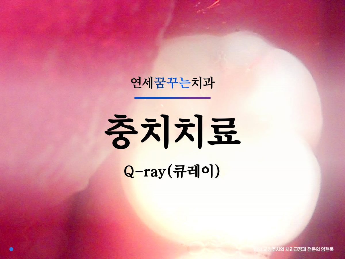 치과에서 이차우식을 놓치지 않는 방법, 큐레이 검사 대표 이미지