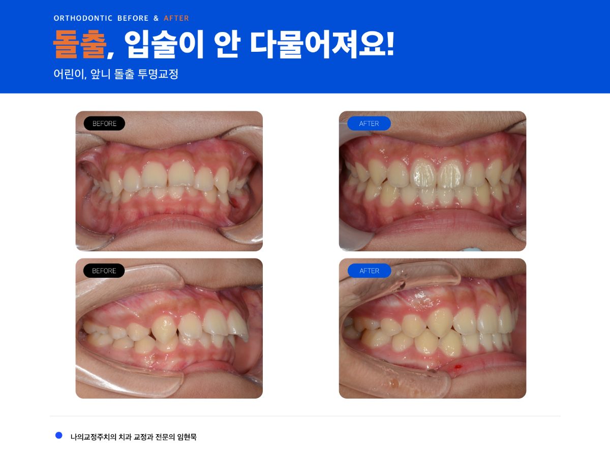 어린이 돌출 비발치 교정 치료 과정 대표 이미지