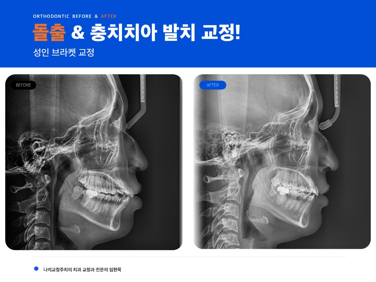 하남 20대 여성 돌출입 교정, 발치 부위는 어떻게 정할까? 대표 이미지