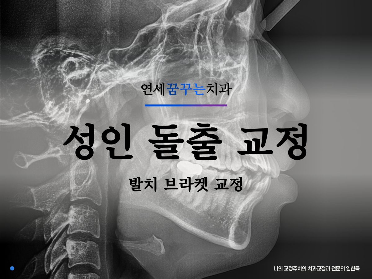 하남 20대 여성 돌출입 교정, 발치 부위는 어떻게 정할까? 관련 이미지 1
