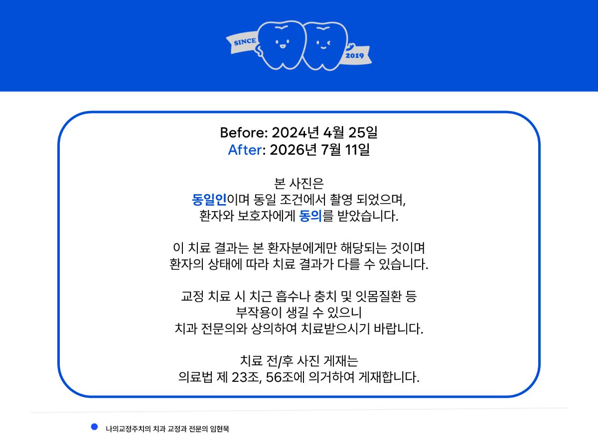 송곳니 안 나올 때, 중심선 틀어짐 원인과 인비절라인 치료 관련 이미지 6