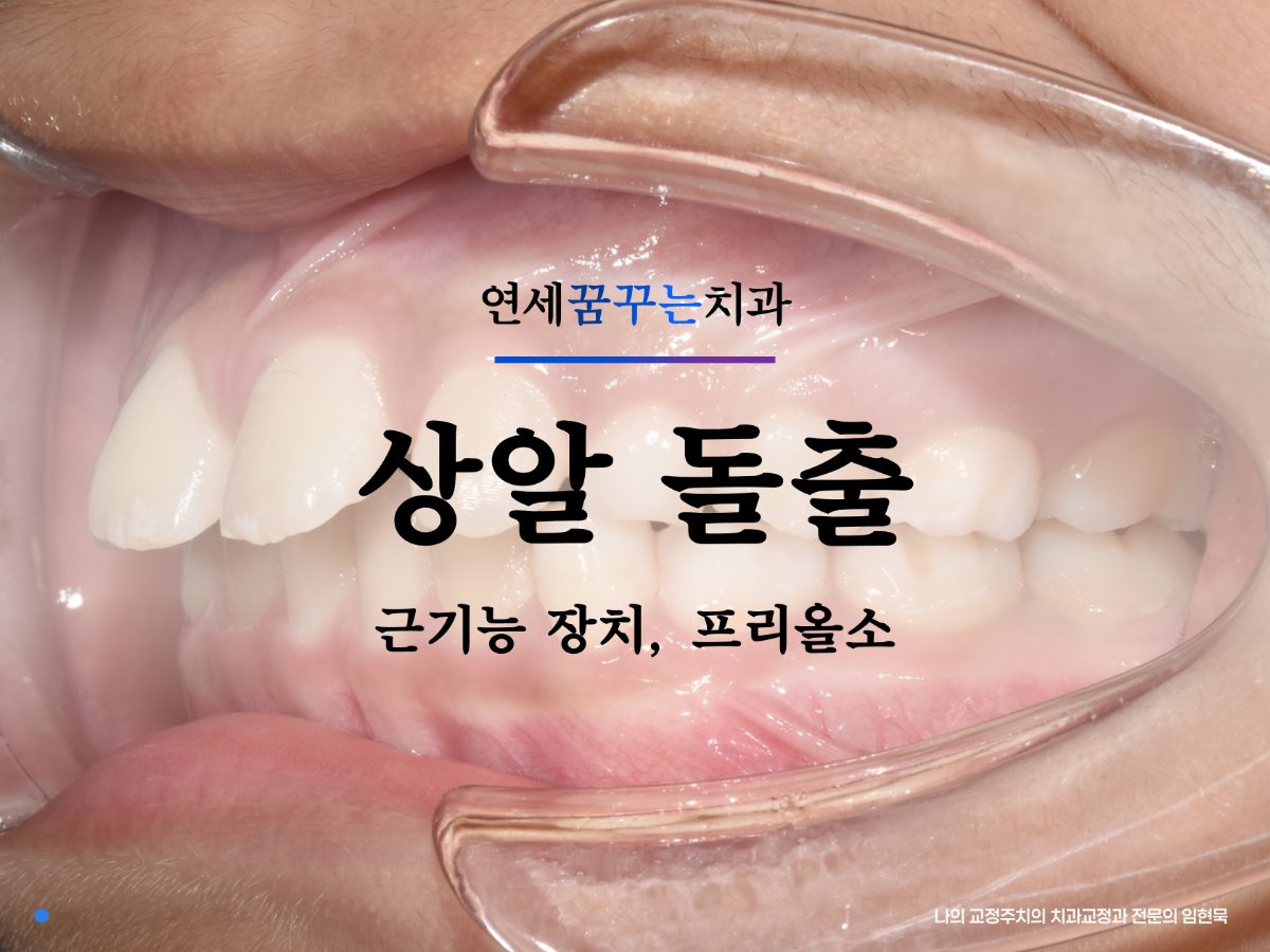 하남 미사 어린이 입호흡과 턱성장 바로잡는 프리올소 근기능장치 교정 대표 이미지