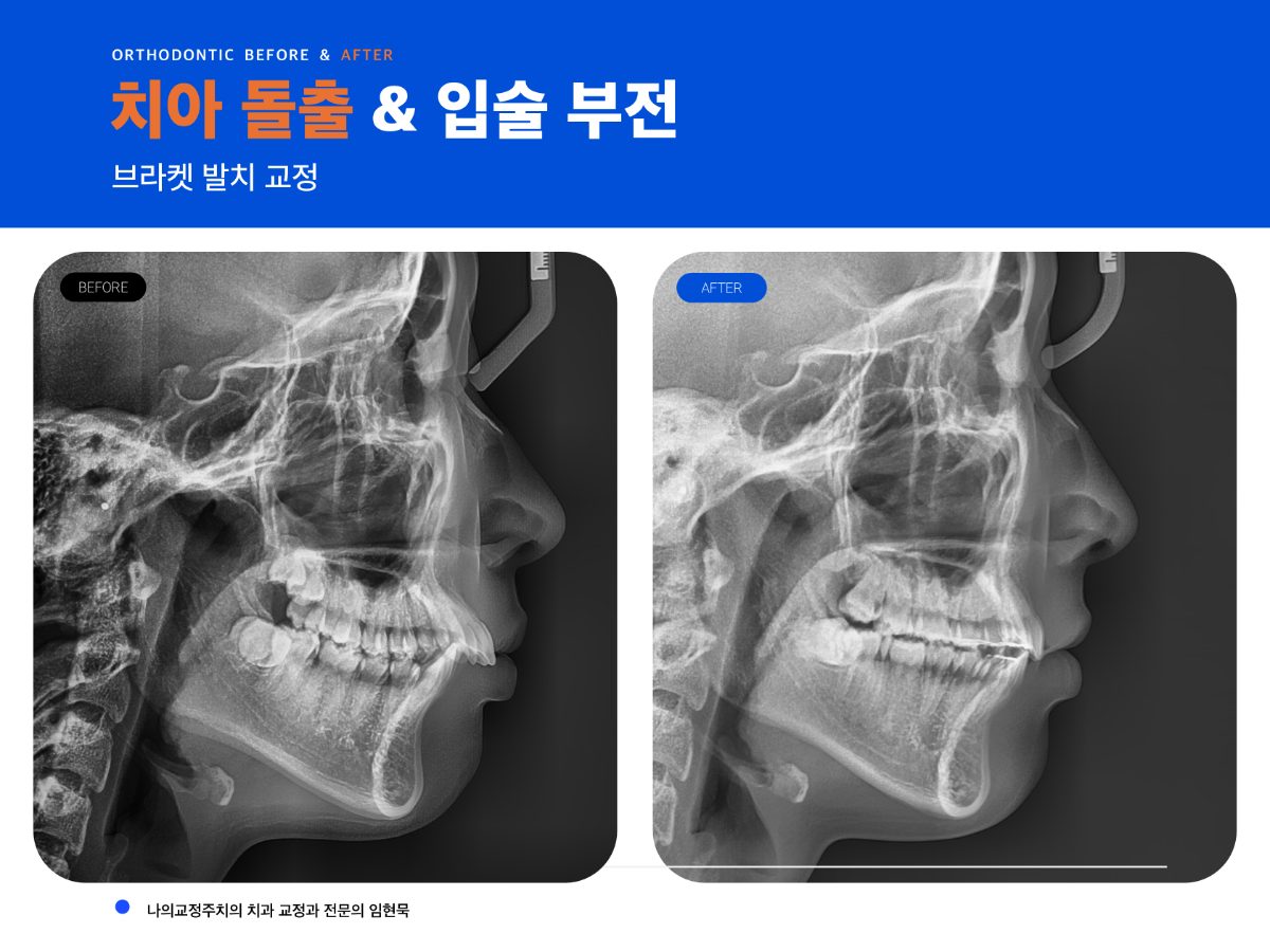 입술이 안 다물어지는 돌출입, 소구치 발치 교정  관련 이미지 1
