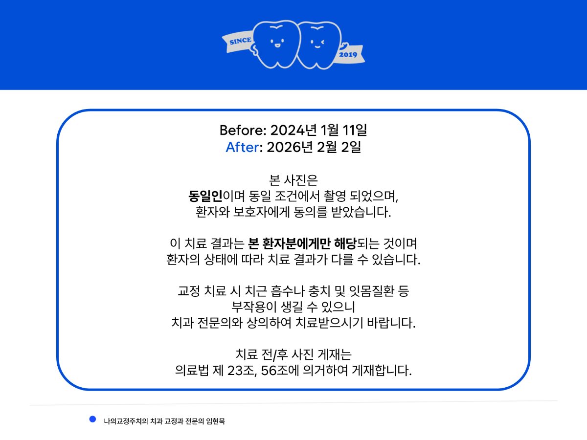 입술이 안 다물어지는 돌출입, 소구치 발치 교정  관련 이미지 15