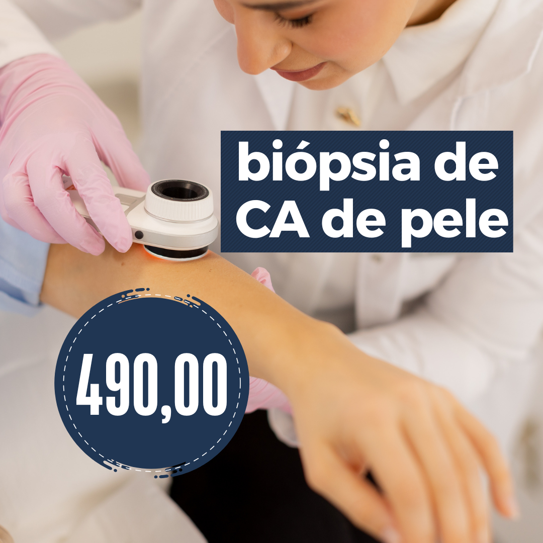 Biópsia de câncer de pele R$ 490,00🔬