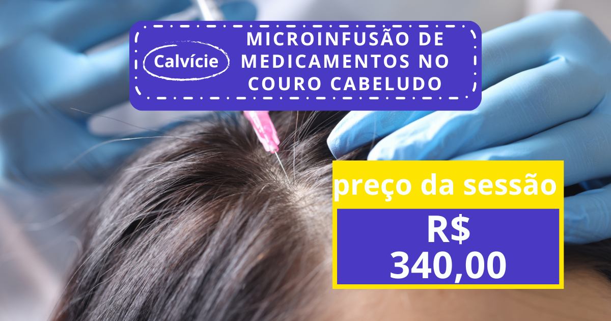 MMP de couro cabeludo - R$ 340,00 por sessão 💉