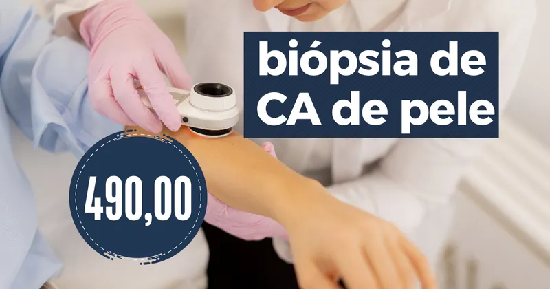 Biópsia de CA de Pele