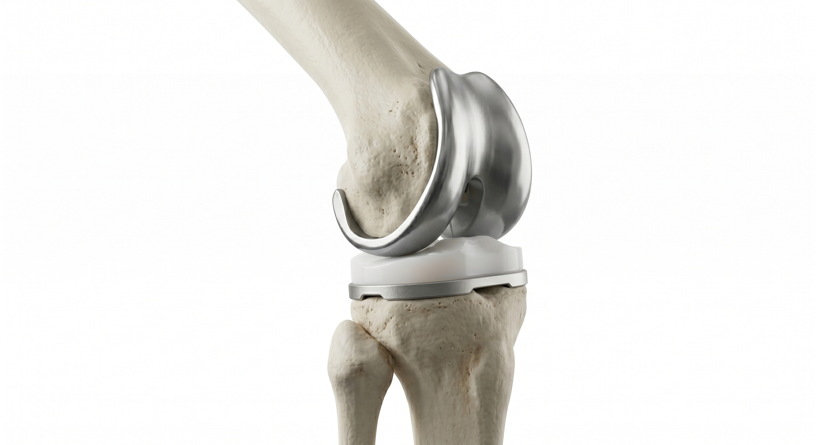 Knee Replacement